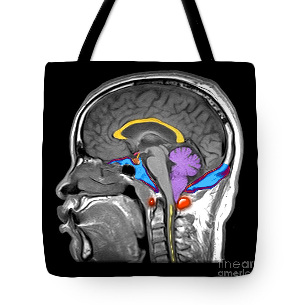 Mri Tote Bag featuring the photograph Chiari I Malformation MRI by Living Art Enterprises and Photo Researchers