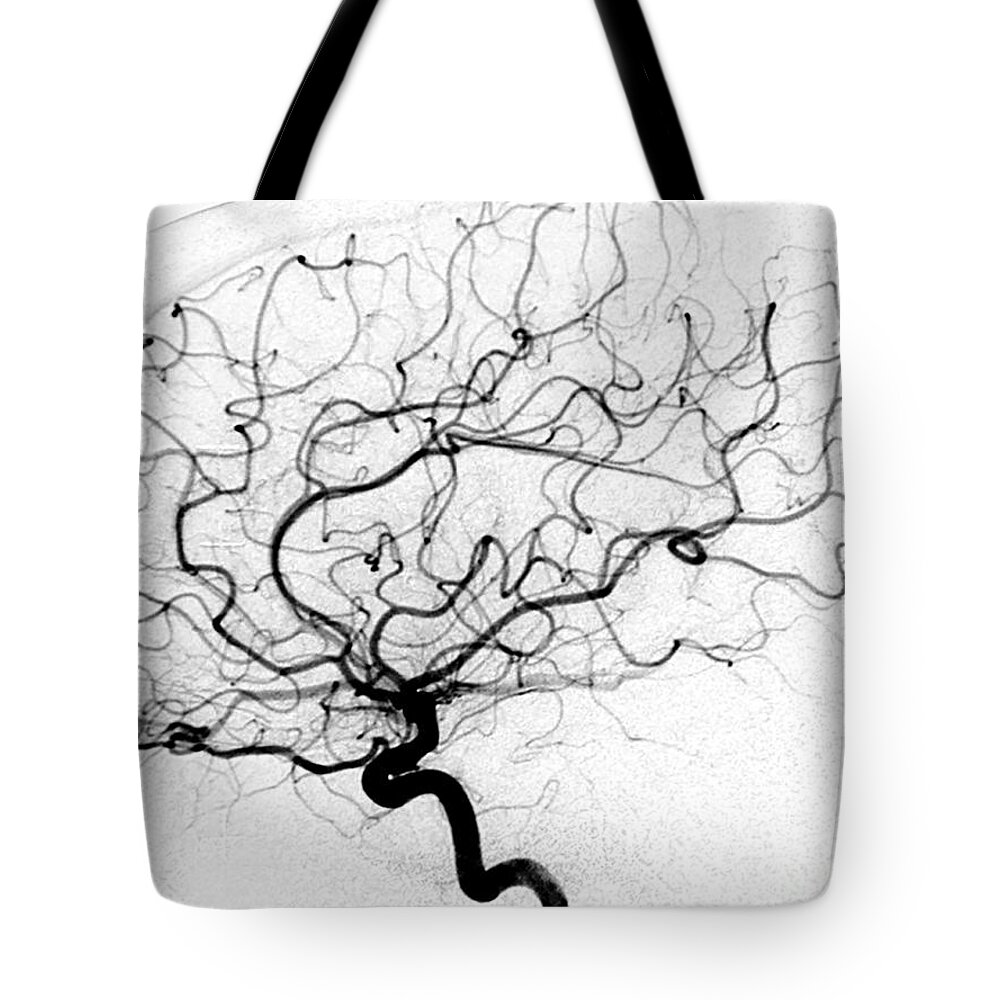 Cerebral Angiogram Tote Bag featuring the photograph Dural Arterial Venous Fistula, Angiogram by Living Art Enterprises