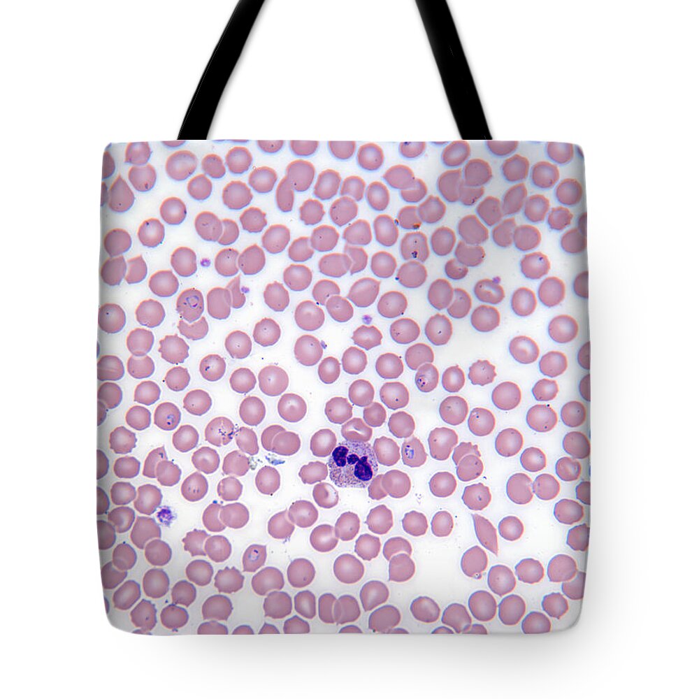 White Background Tote Bag featuring the photograph Malarial Blood Cells by michael J. Klein, M.d.