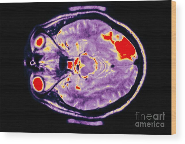 Colorized Wood Print featuring the photograph Skull Showing Region Of Stroke In Brain #1 by Lunagrafix