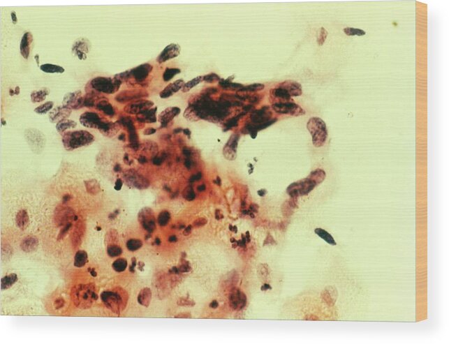 Severe Dysplasia Wood Print featuring the photograph Lm Of Cervical Smear Showing Severe Dysplasia #3 by Science Photo Library.