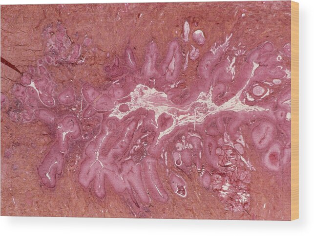 Cervix Wood Print featuring the photograph Cervical cancer by Science Photo Library - CNRI/SPL