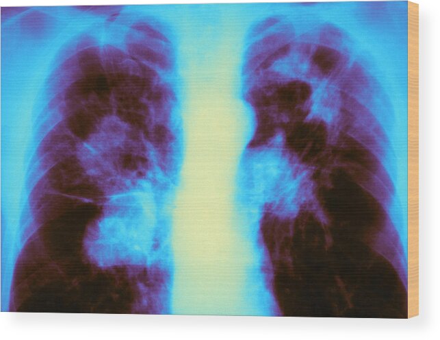 Abnormal Wood Print featuring the photograph Tuberculosis Infection by Michael Abbey