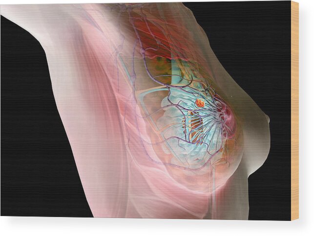Horizontal Wood Print featuring the digital art Breast Cancer by MedicalRF.com