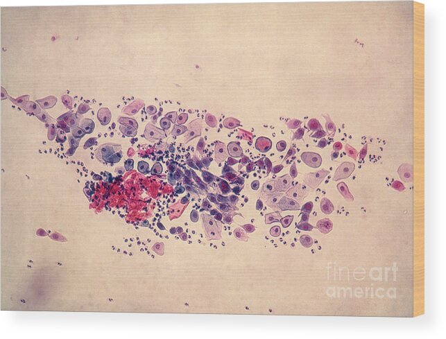 Medical Wood Print featuring the photograph Pap Smear, Parabasal Cells by Science Source