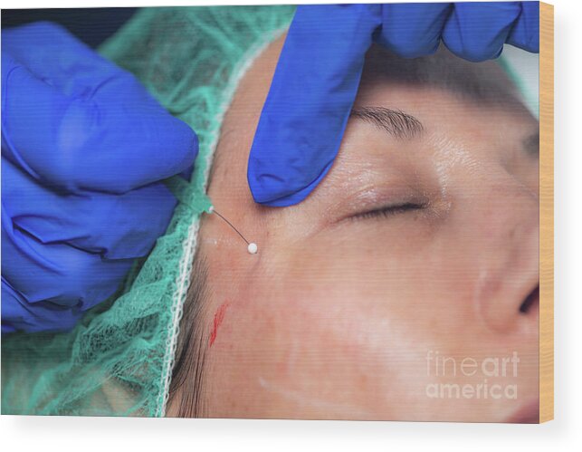 Mesotherapy Wood Print featuring the photograph Mesotherapy Thread Face Lift Procedure #13 by Microgen Images/science Photo Library