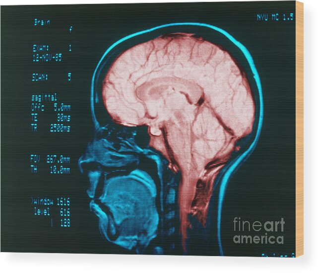 Angiography Wood Print featuring the photograph Cerebral Angiography by Science Source