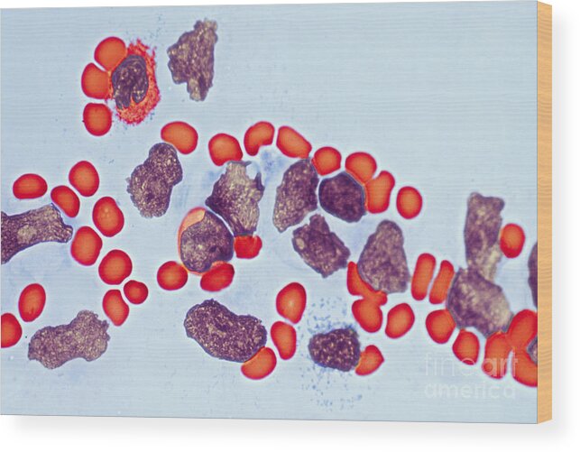 Leukemia Wood Print featuring the photograph Leukemia #1 by Biology Pics