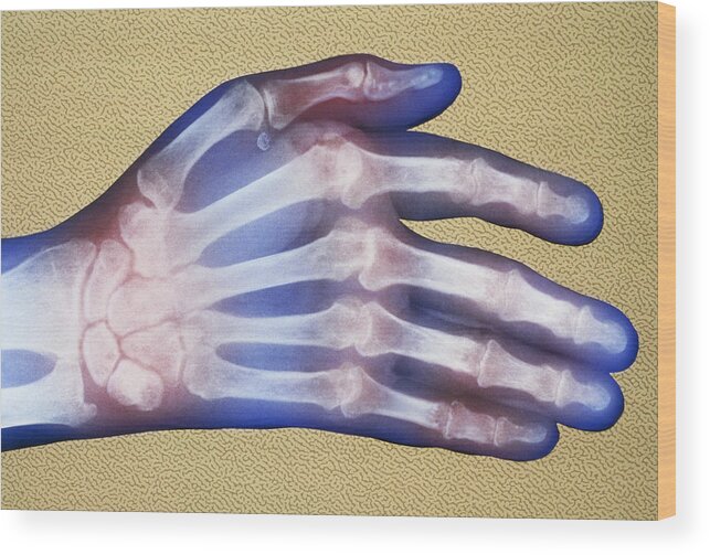 Arthritic Wood Print featuring the photograph X-ray, Rheumatoid Arthritis #1 by Chris Bjornberg
