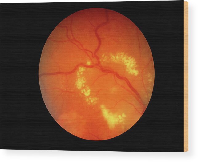 Diabetic Retinopathy Wood Print featuring the photograph Fundus Camera Image Of A Diabetic Retina by Science Photo Library