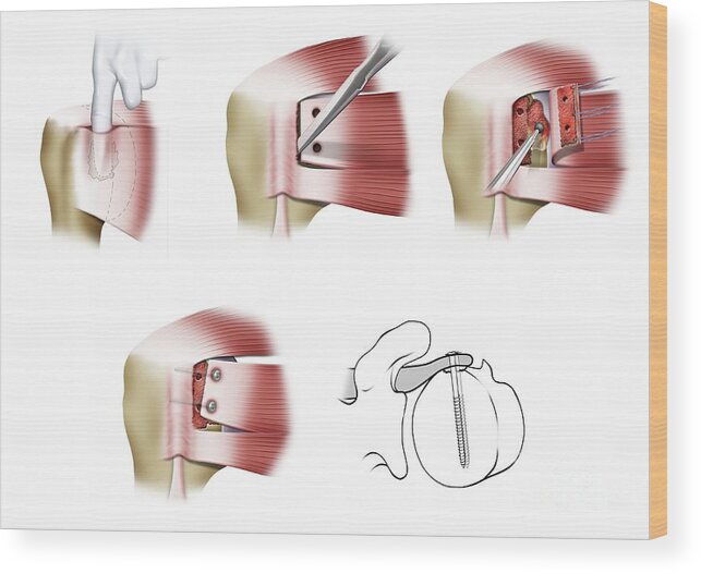 Mclaughlin Procedure Wood Print featuring the photograph Mclaughlin Procedure Shoulder Surgery by Maurizio De Angelis/science Photo Library