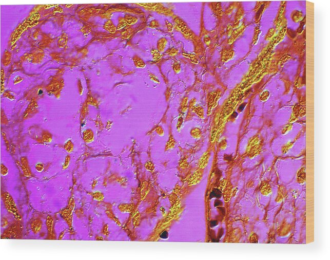 Problems Wood Print featuring the photograph Placental Villi With Syphillis by michael J. Klein, M.d.