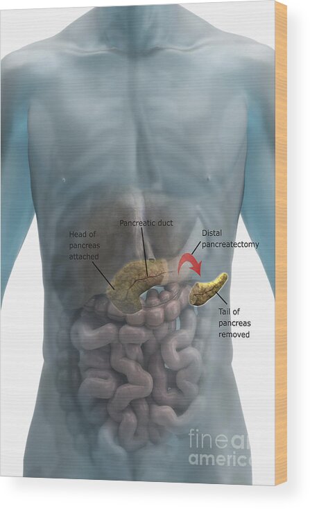 Transparent Skin Wood Print featuring the photograph Distal Pancreatectomy by Science Picture Co