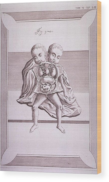 History Wood Print featuring the photograph Conjoined Twins With Common Torso by Everett