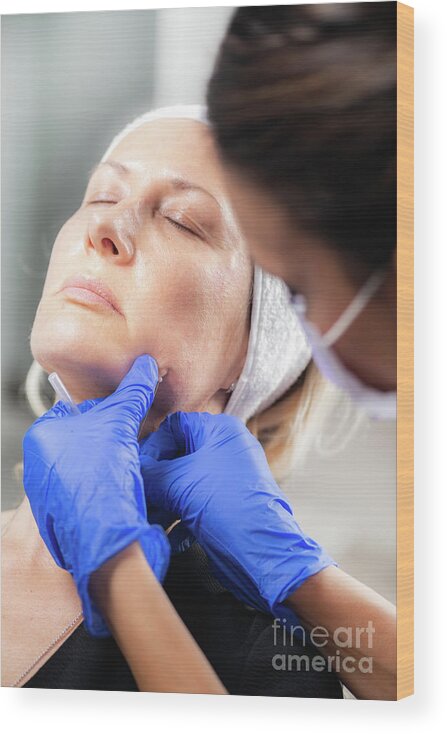 Facelift Wood Print featuring the photograph Mesotherapy Thread Face Lift Procedure #10 by Microgen Images/science Photo Library