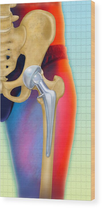 Art Wood Print featuring the photograph Prosthetic Hip Replacement by Chris Bjornberg