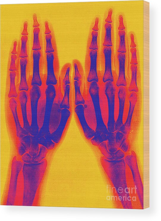 Historic Wood Print featuring the photograph X-ray Of Two Normal Hands 1896 #3 by Science Source