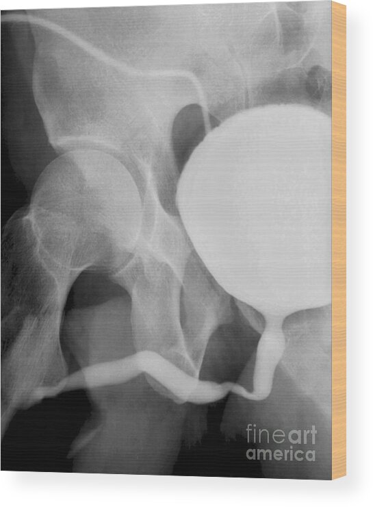 Bladder Wood Print featuring the photograph Voiding Cystourethrogram, X-rays #3 by Zephyr