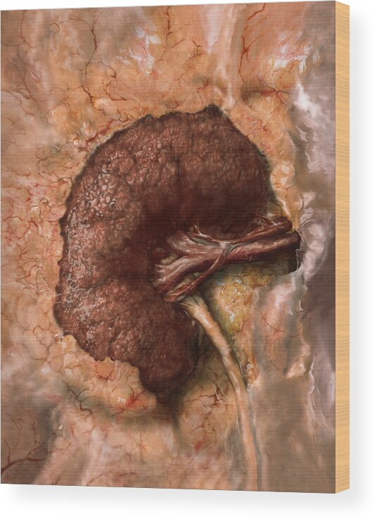 Abnormal Wood Print featuring the photograph Kidney Disease Progression, 3 Of 3 by Anatomical Travelogue