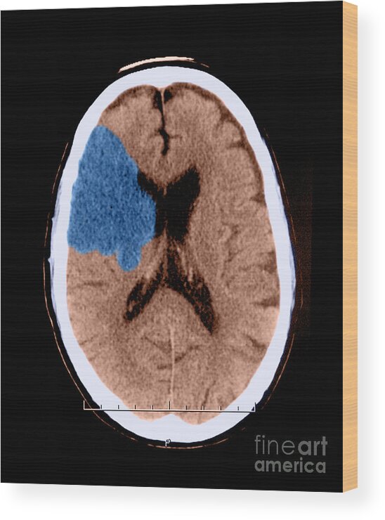 Ct Scan Wood Print featuring the photograph Ct Of Stroke #1 by Medical Body Scans