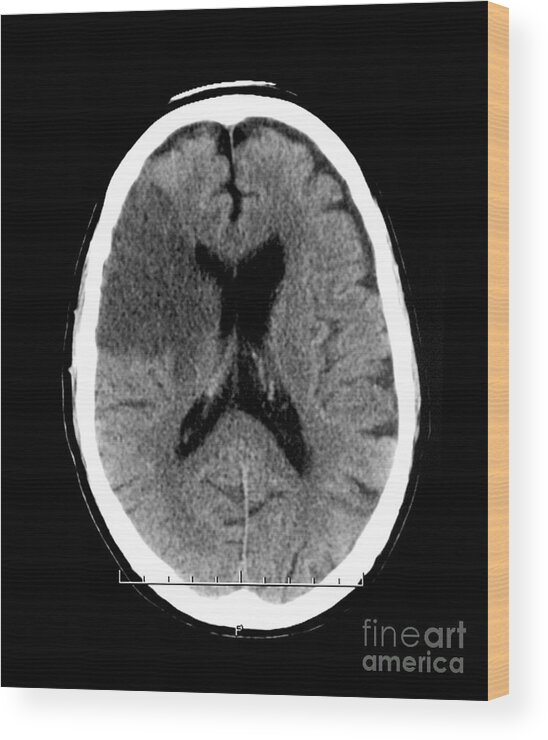 Ct Scan Wood Print featuring the photograph Ct Of Stroke #4 by Medical Body Scans