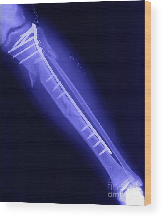 Leg Wood Print featuring the photograph Fractured Tibia by Ted Kinsman
