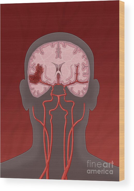 Medical Wood Print featuring the photograph Hemorrhagic Stroke, Illustration by Monica Schroeder