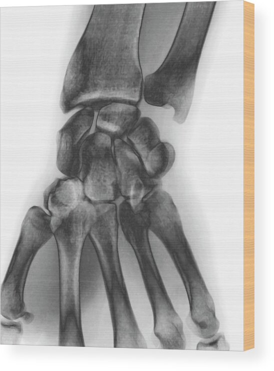 White Background Wood Print featuring the photograph Normal Wrist, X-ray #1 by Zephyr