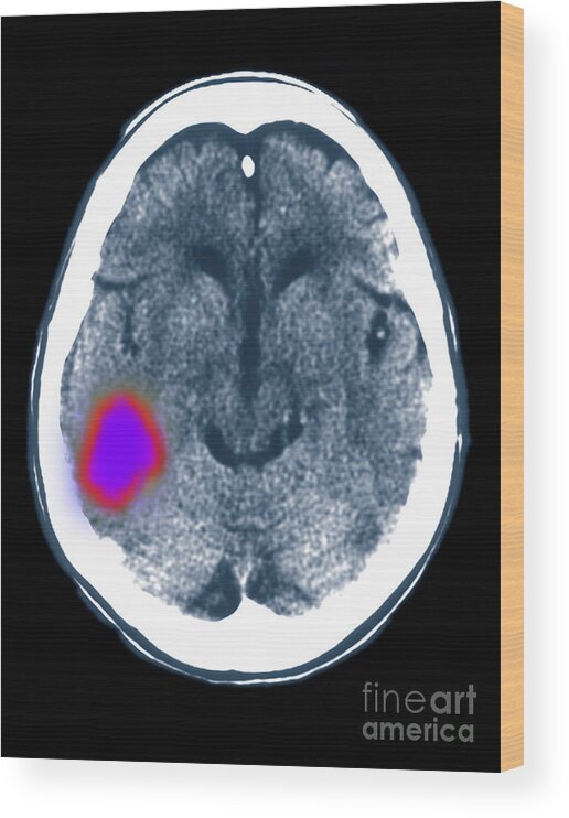 Ct Scan Wood Print featuring the photograph Cerebral Ct Scan Showing Stroke by Scott Camazine