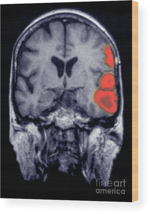 Brain Wood Print featuring the photograph Mri Of Brain Showing A Stroke by Scott Camazine