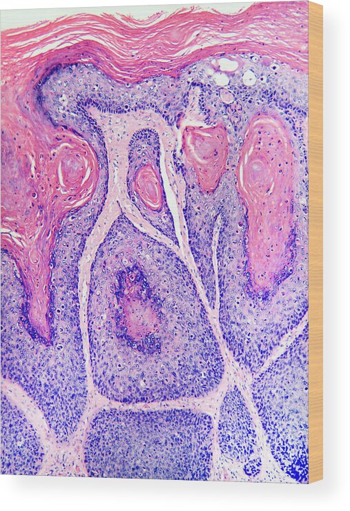 Squamous In Situ Wood Print featuring the photograph Skin Cancer, Bowens Disease, Lm by Garry DeLong