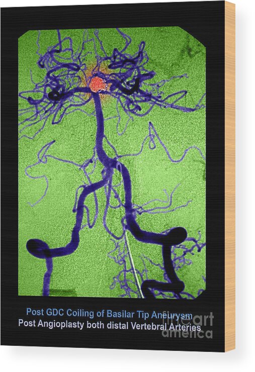 Abnormal Blood Vessel Wood Print featuring the photograph Cerebral Angiogram by Medical Body Scans