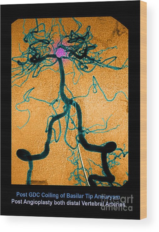 Abnormal Blood Vessel Wood Print featuring the photograph Cerebral Angiogram #6 by Medical Body Scans
