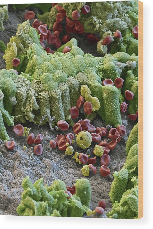 Abnormal Wood Print featuring the photograph Damaged Gallbladder, Sem #3 by Eye of Science
