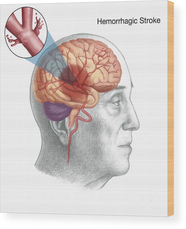 Science Wood Print featuring the photograph Hemorrhagic Stroke by Spencer Sutton