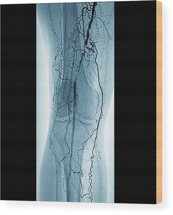 Black Background Wood Print featuring the photograph Peripheral Vascular Disease In Diabetes by Zephyr/science Photo Library