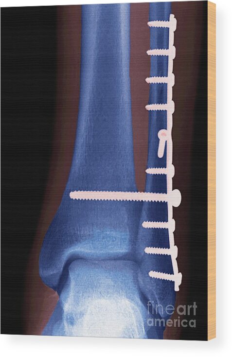 Ankle Wood Print featuring the photograph Ankle Fracture by Steve Gschmeissner/science Photo Library