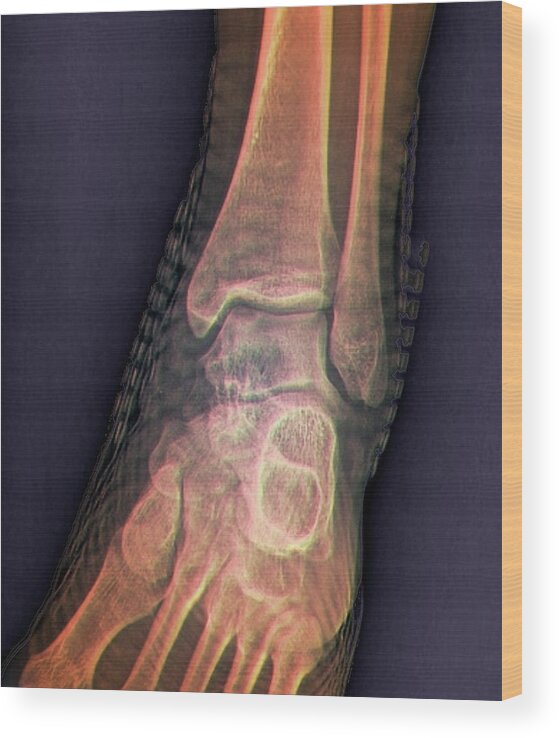 Radiography Wood Print featuring the photograph Healthy Ankle Joint #3 by Zephyr/science Photo Library