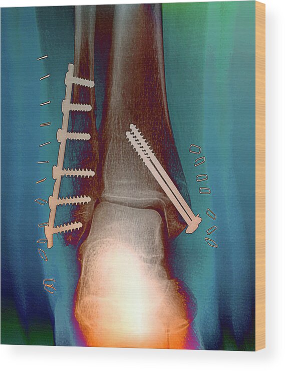 Break Wood Print featuring the photograph Pinned Ankle Fractures by Zephyr/science Photo Library