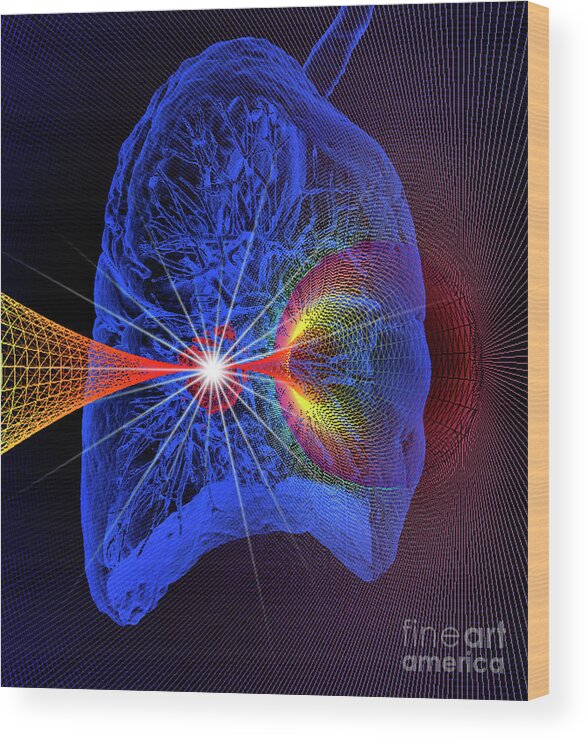 Disease Wood Print featuring the photograph Lung Cancer Radiotherapy #1 by K H Fung/science Photo Library