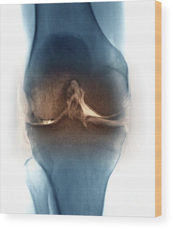 58 Wood Print featuring the photograph Osteoarthritis Of The Knee Joint #1 by Zephyr/science Photo Library