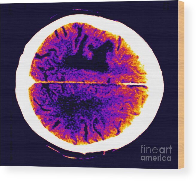 Radiology Wood Print featuring the photograph Brain Edema #2 by Scott Camazine