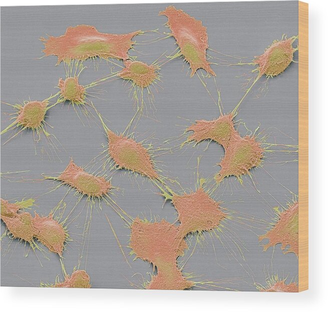 Abnormal Wood Print featuring the photograph Prostate Cancer Cells by Steve Gschmeissner