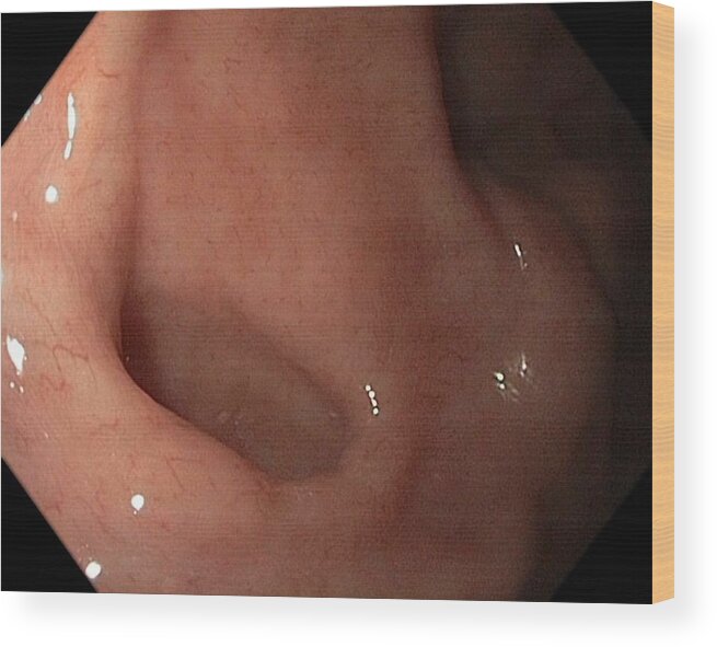 Endoscope View Wood Print featuring the photograph Diverticulum In The Stomach by Gastrolab