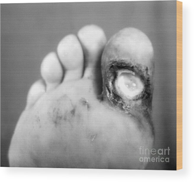 Bacterial Wood Print featuring the photograph Syphilis Ulcer by Science Source