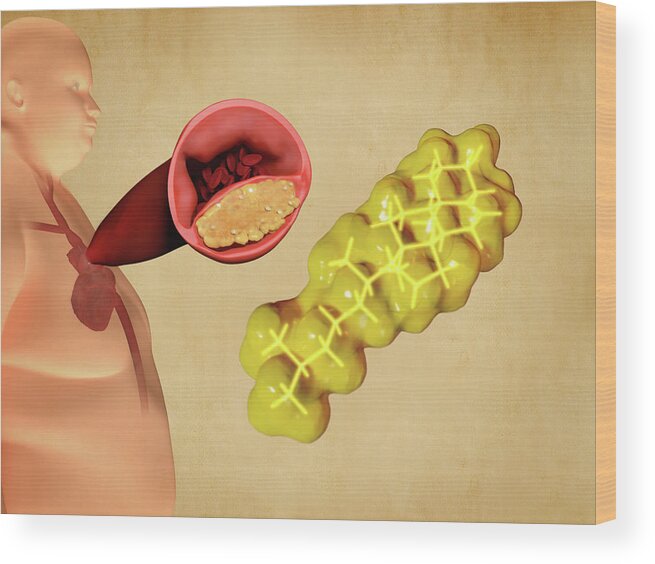 Art Wood Print featuring the photograph Cholesterol And Atherosclerosis, Artwork by Juan Gaertner