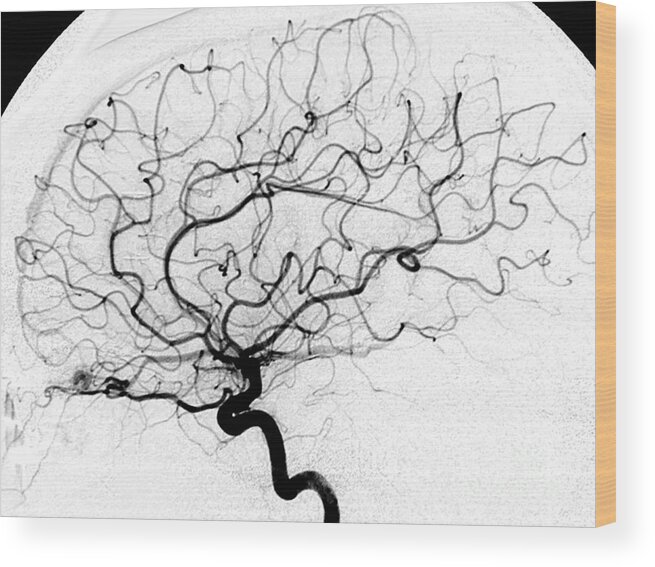 Cerebral Angiogram Wood Print featuring the photograph Dural Arterial Venous Fistula, Angiogram by Living Art Enterprises
