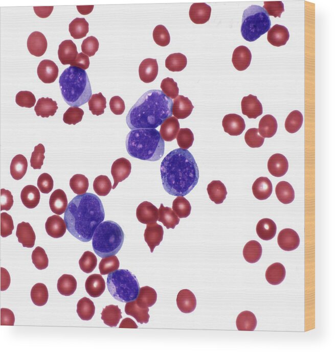 Abnormal Wood Print featuring the photograph Acute Myeloid Leukemia by Steve Gschmeissner/science Photo Library