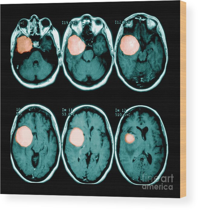 Mri Wood Print featuring the photograph Brain Tumor by Medical Body Scans