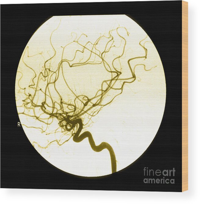 Cerebral Angiogram Wood Print featuring the photograph Internal Carotid Cerebral Angiogram by Medical Body Scans